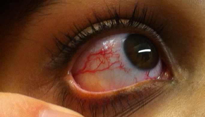 Conjunctival telangiectasia in ataxia-telangiectasia