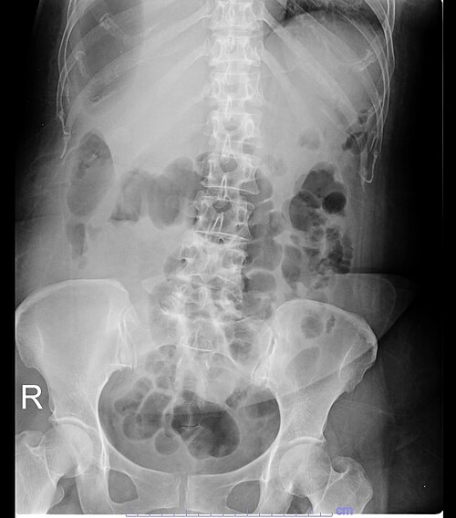 Free air under diaphragm