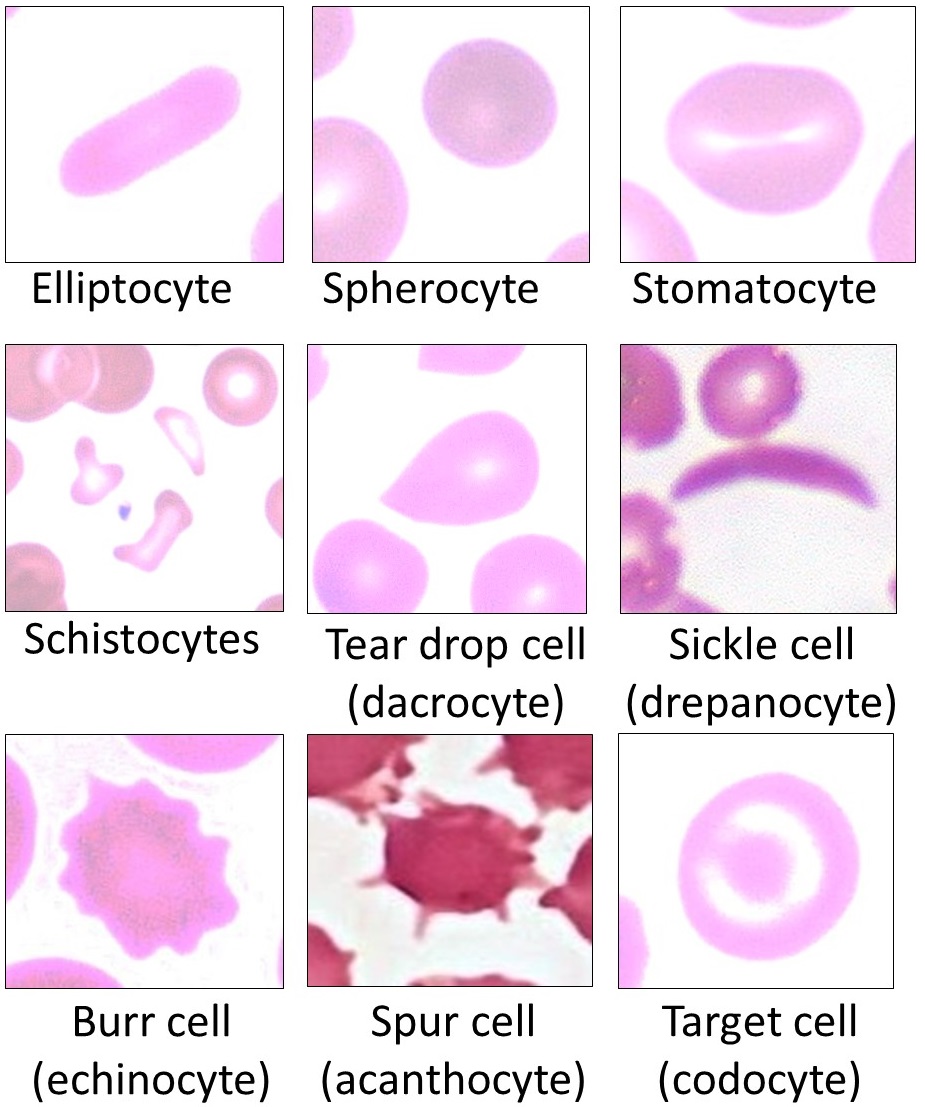 RBC poikilocyte morphology reference including bite cells