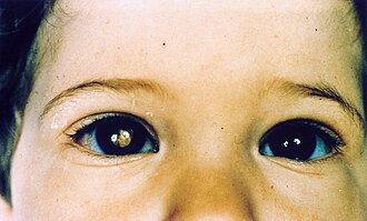 Leukocoria: white pupillary reflex of retinoblastoma