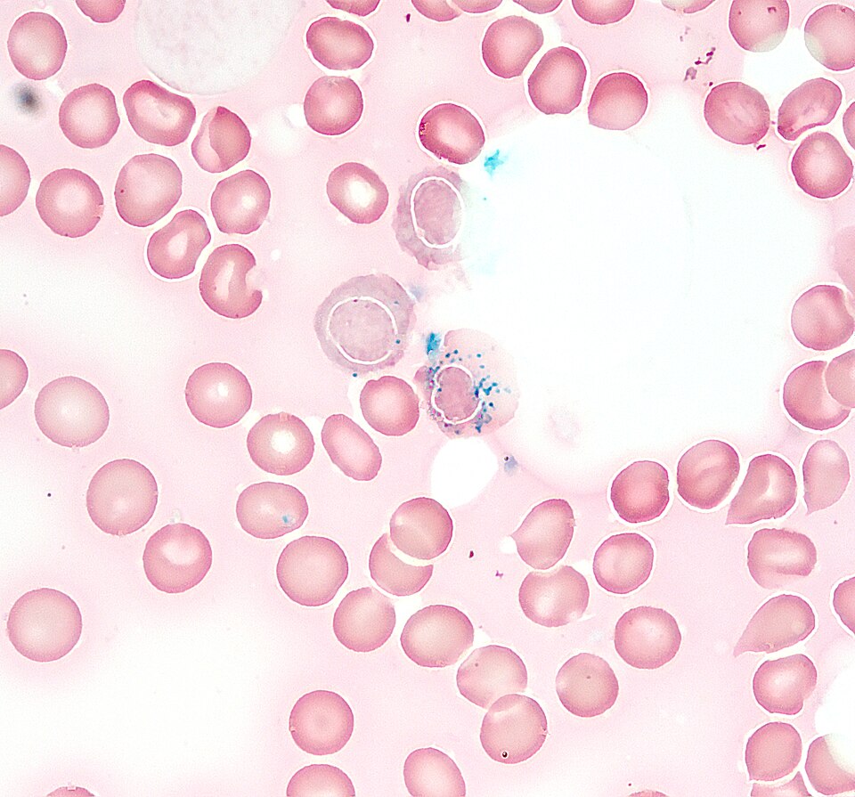 Ringed sideroblast on bone marrow smear