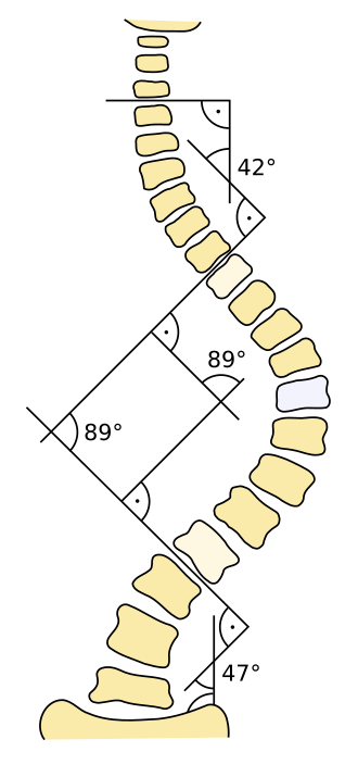 Adam's forward bend test showing rib hump
