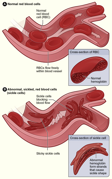 Sickle cell blood smear