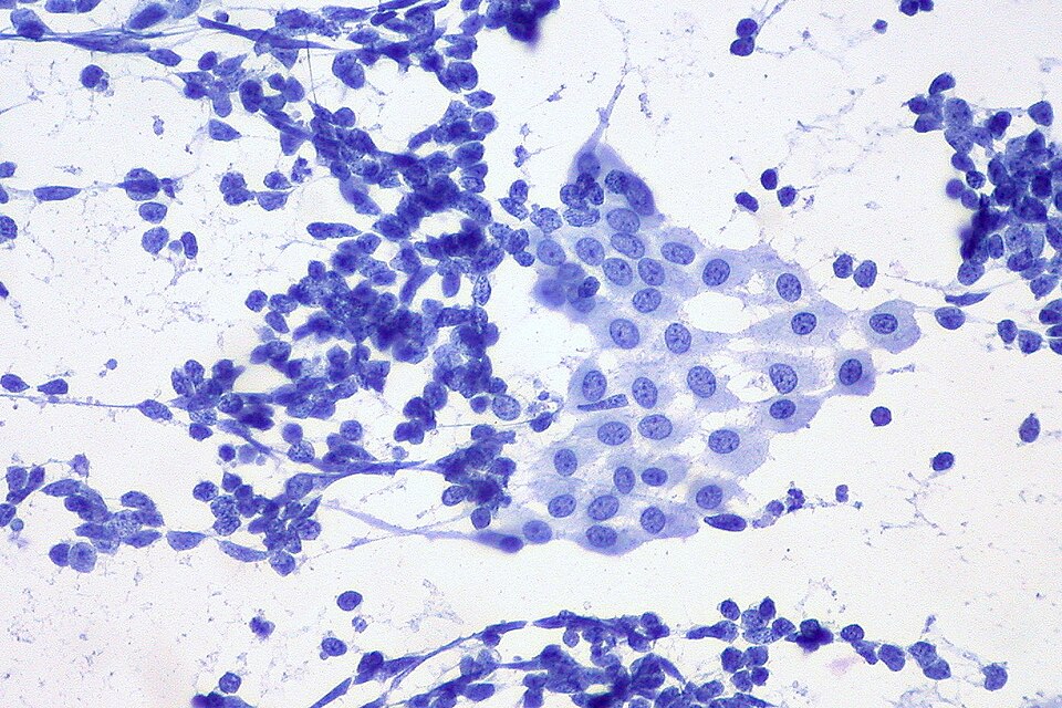 Small cell lung carcinoma oat cell histology