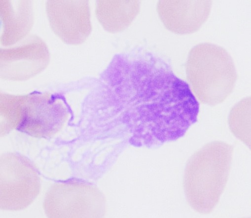 Peripheral blood smear showing abnormal cells