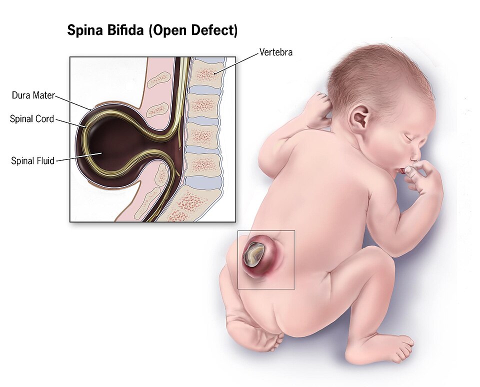 Spina bifida illustration