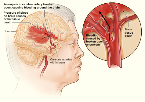Hemorrhagic stroke anatomical illustration