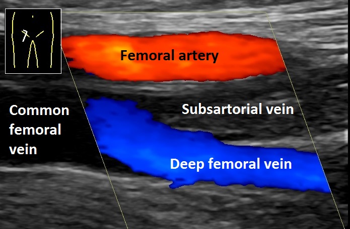 Duplex ultrasound of femoral vein deep vein thrombosis