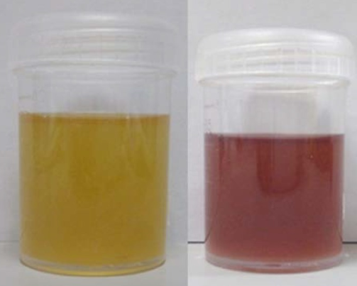 Dark reddish urine from a patient with porphyria showing oxidized porphobilinogen