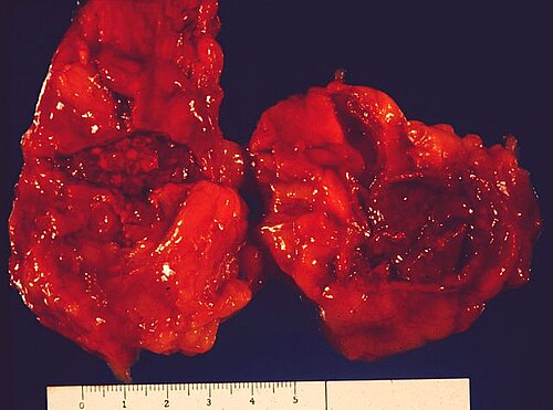 Bilateral adrenal hemorrhage in fulminant meningococcal sepsis