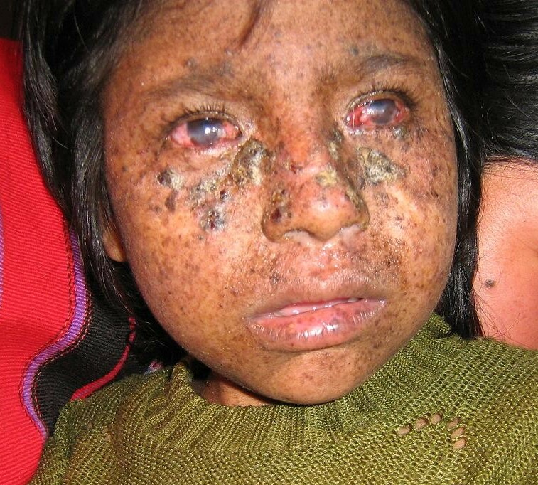 Facial skin changes in xeroderma pigmentosum