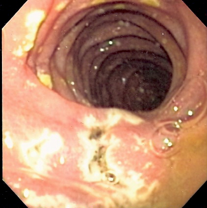 Endoscopy showing multiple duodenal ulcers in Zollinger-Ellison syndrome