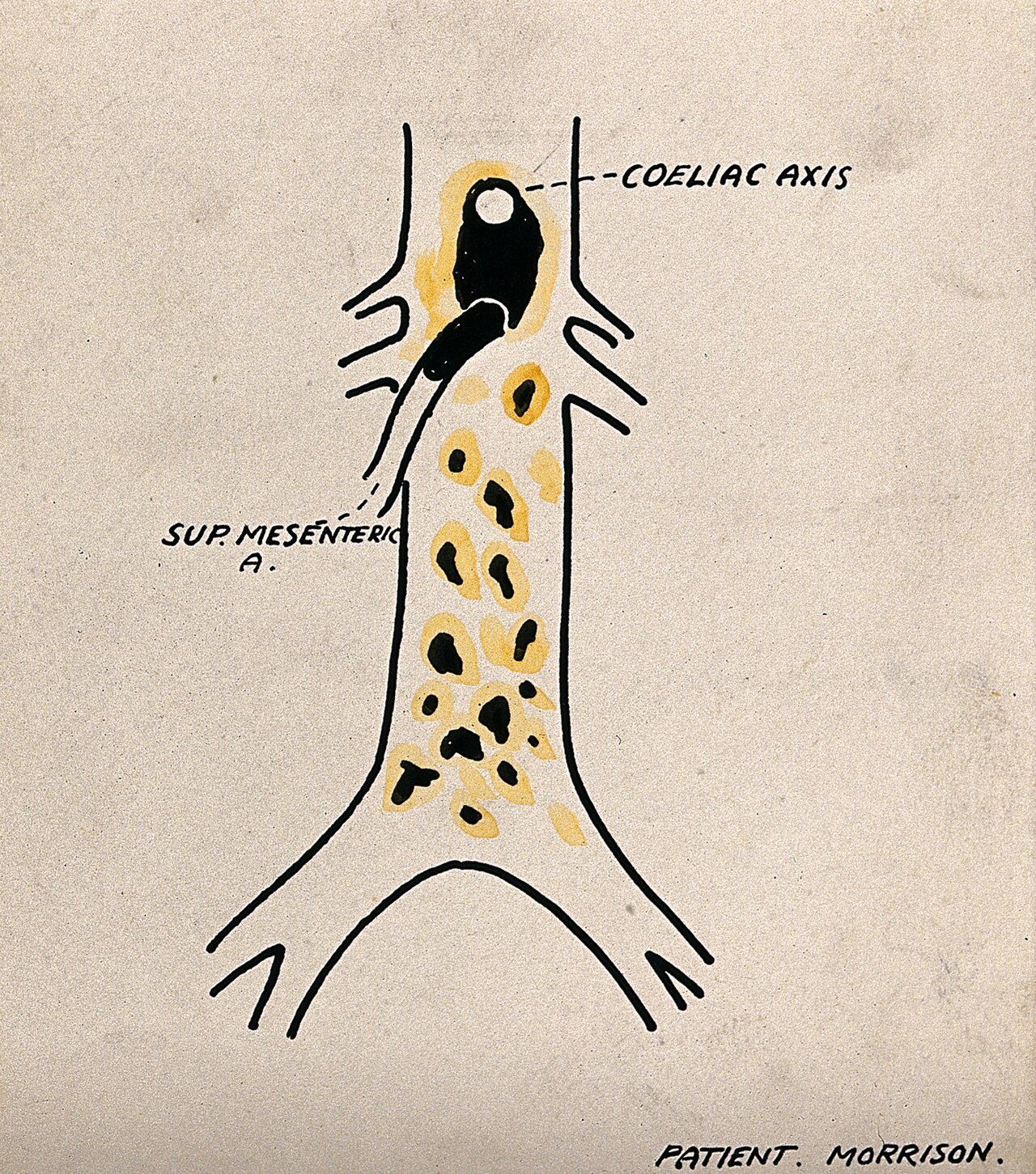 Abdominal aorta with the coeliac axis and superior mesenteric artery labeled, ending at the iliac bifurcation