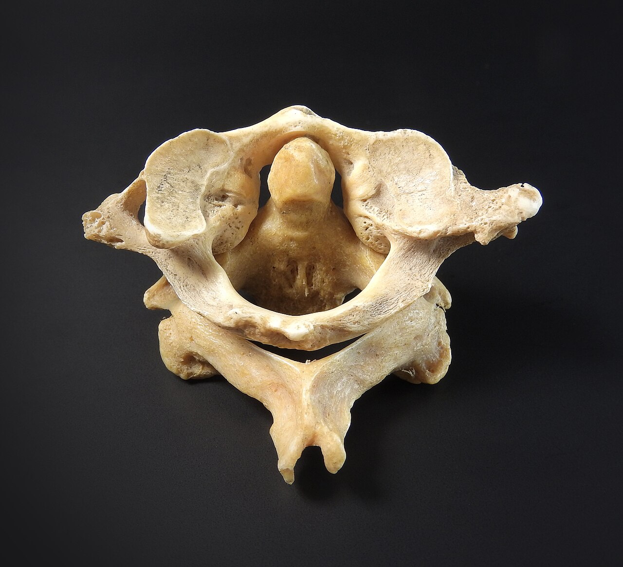 Atlas and axis articulation showing the dens