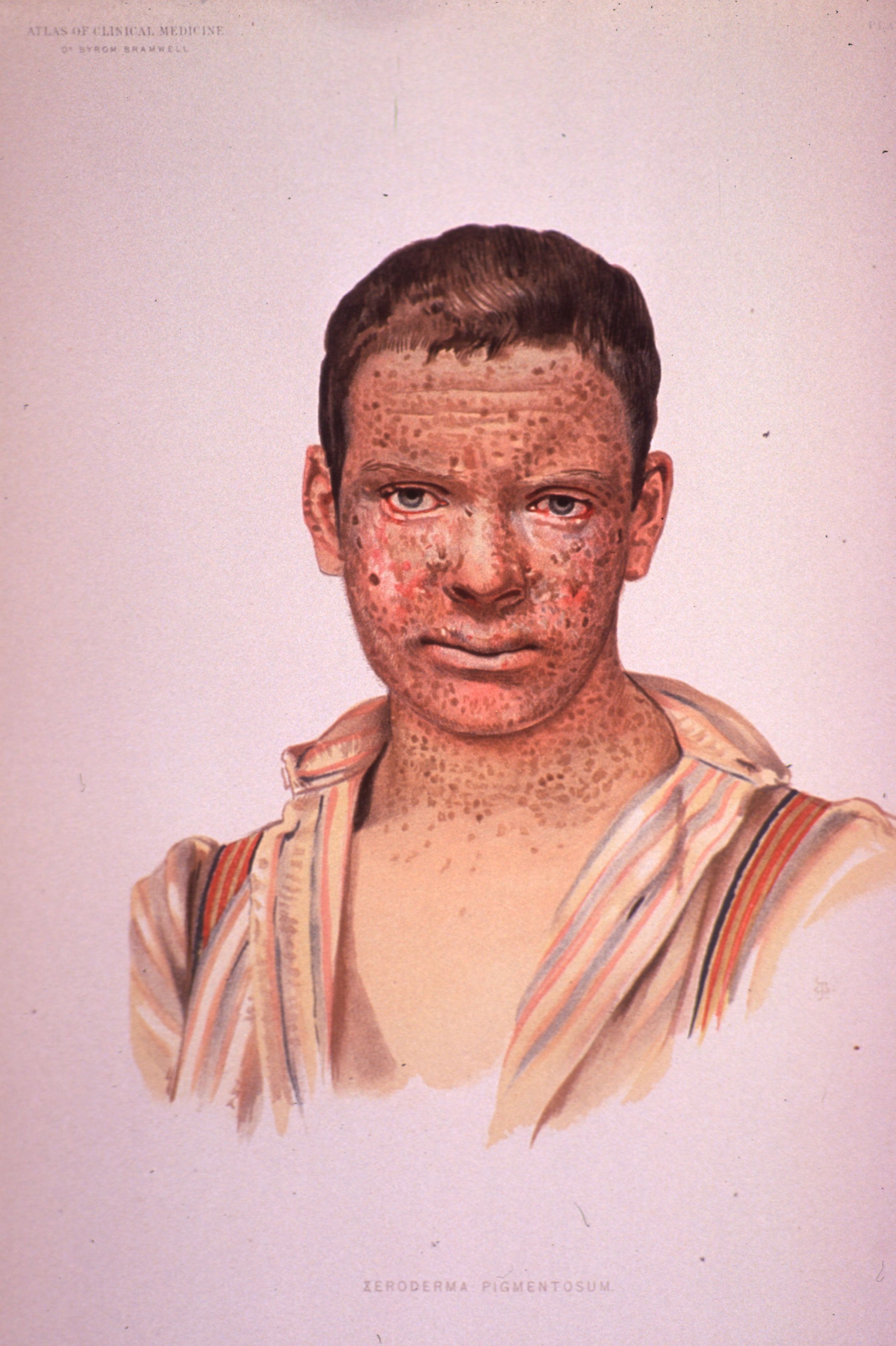 Xeroderma pigmentosum: facial freckling with erythema and red, photosensitive eyes