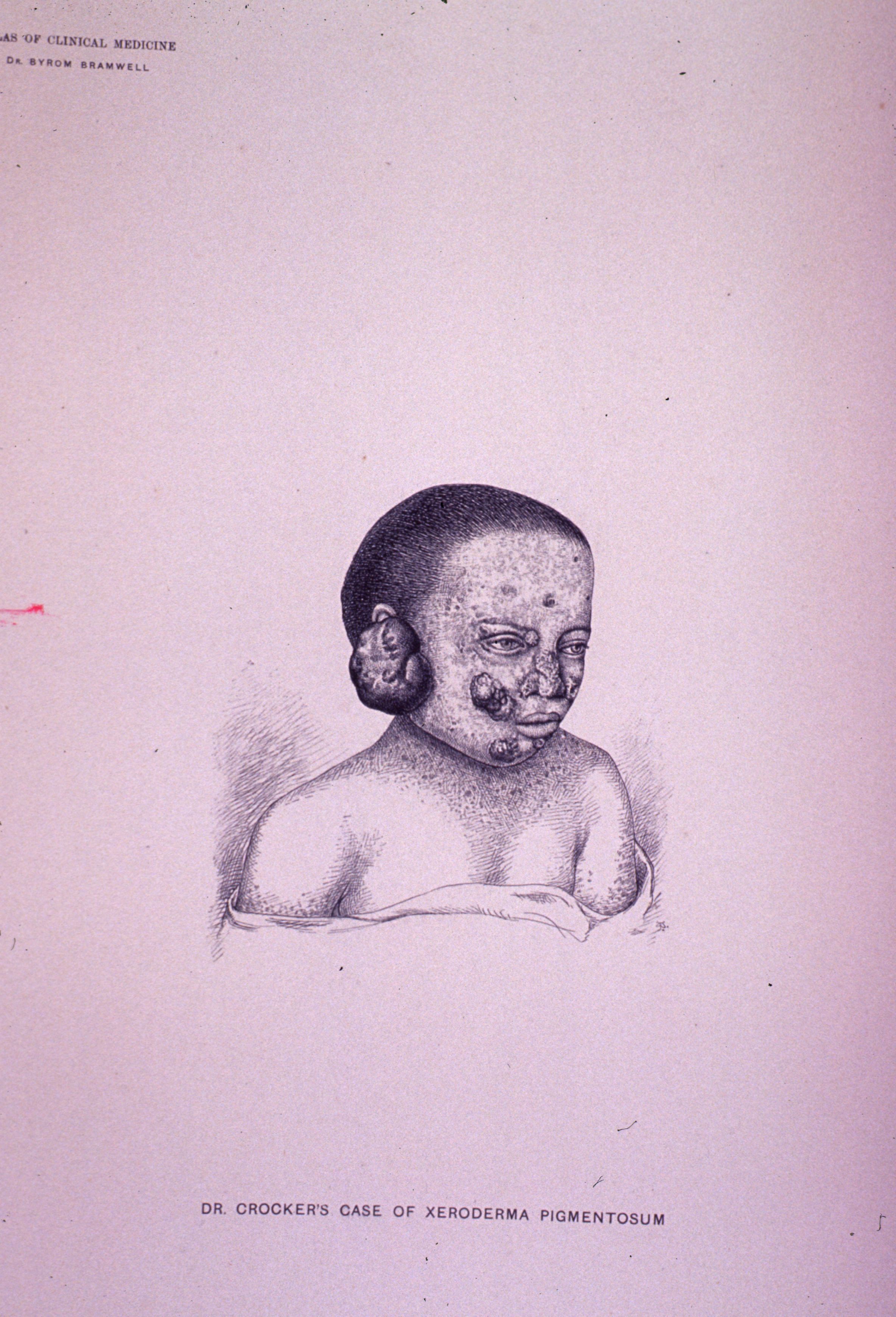 Xeroderma pigmentosum: advanced disease with cutaneous tumors on the face