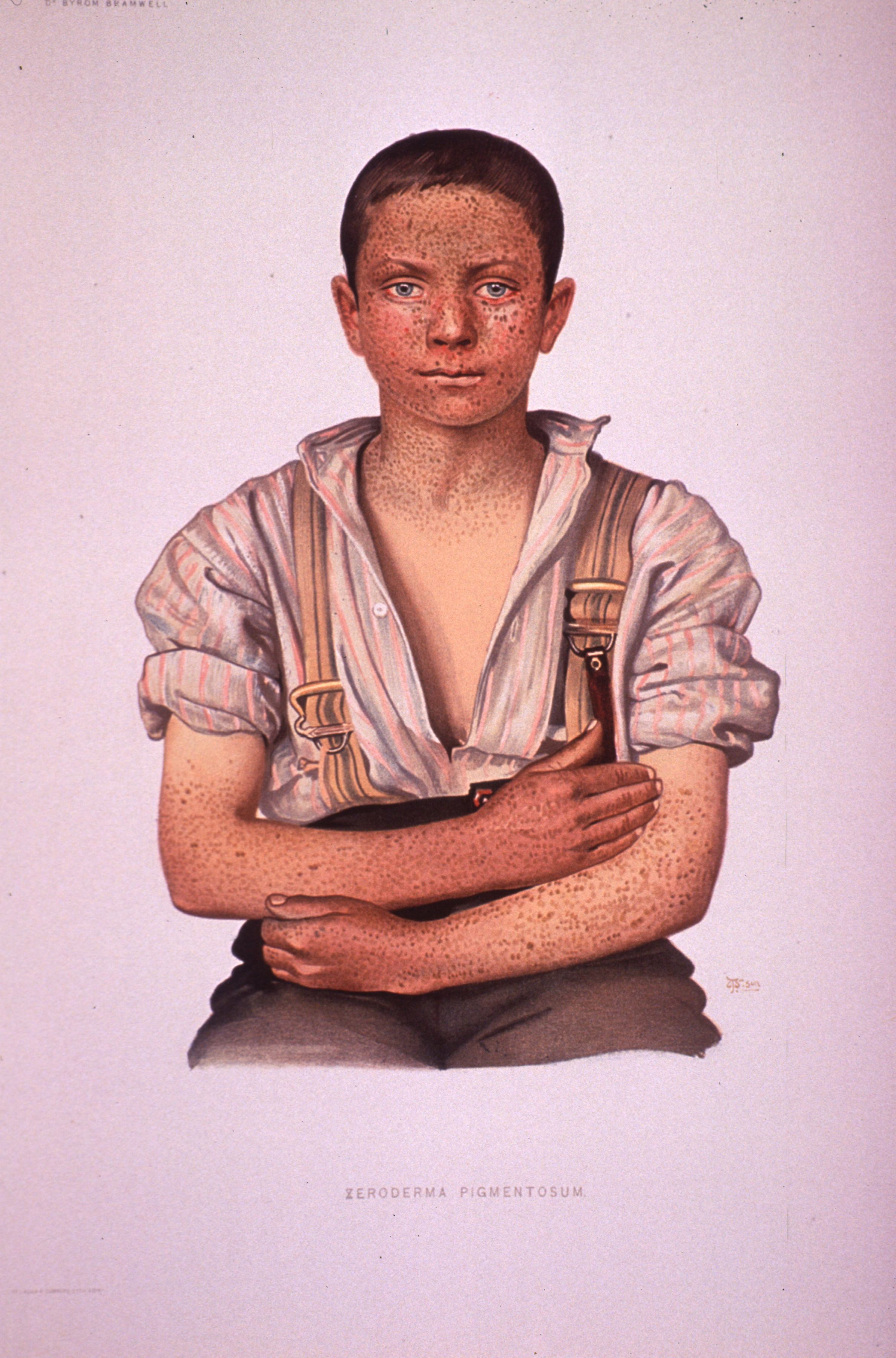 Xeroderma pigmentosum: diffuse freckling on the face, neck, and forearms of a boy