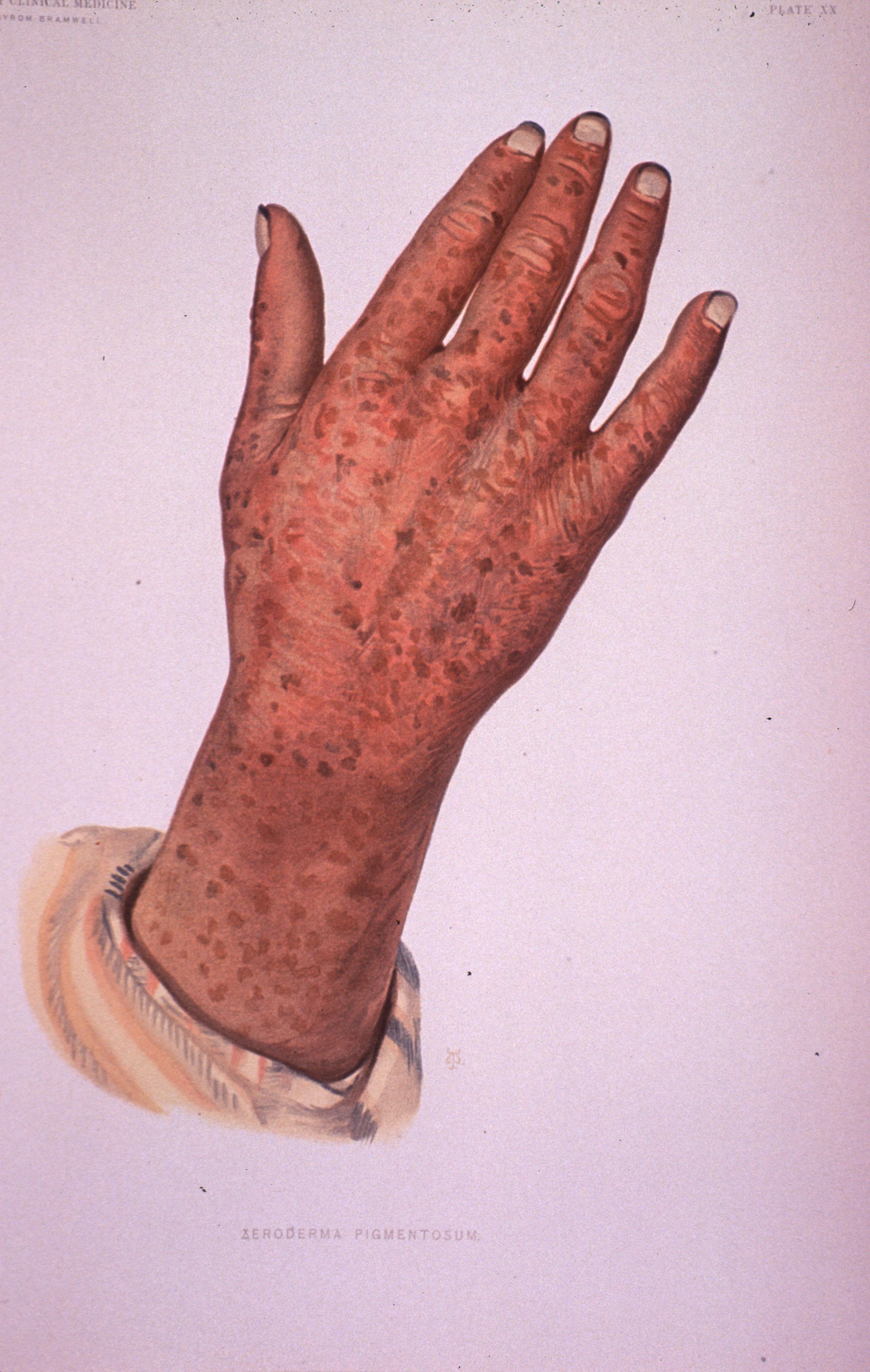 Xeroderma pigmentosum: freckling and actinic damage on the back of the hand and forearm