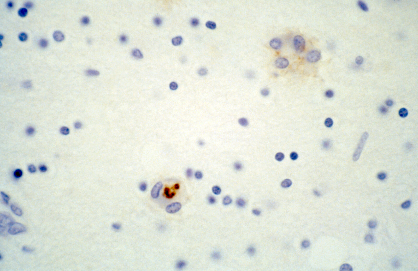 Brain: HIV encephalitis, microglial nodule with a multinucleated giant cell