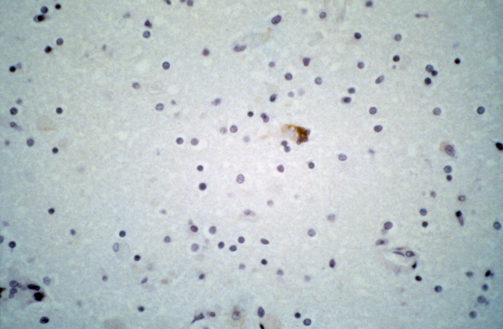 Brain: HIV encephalitis, immunostain highlighting infected microglia and macrophages