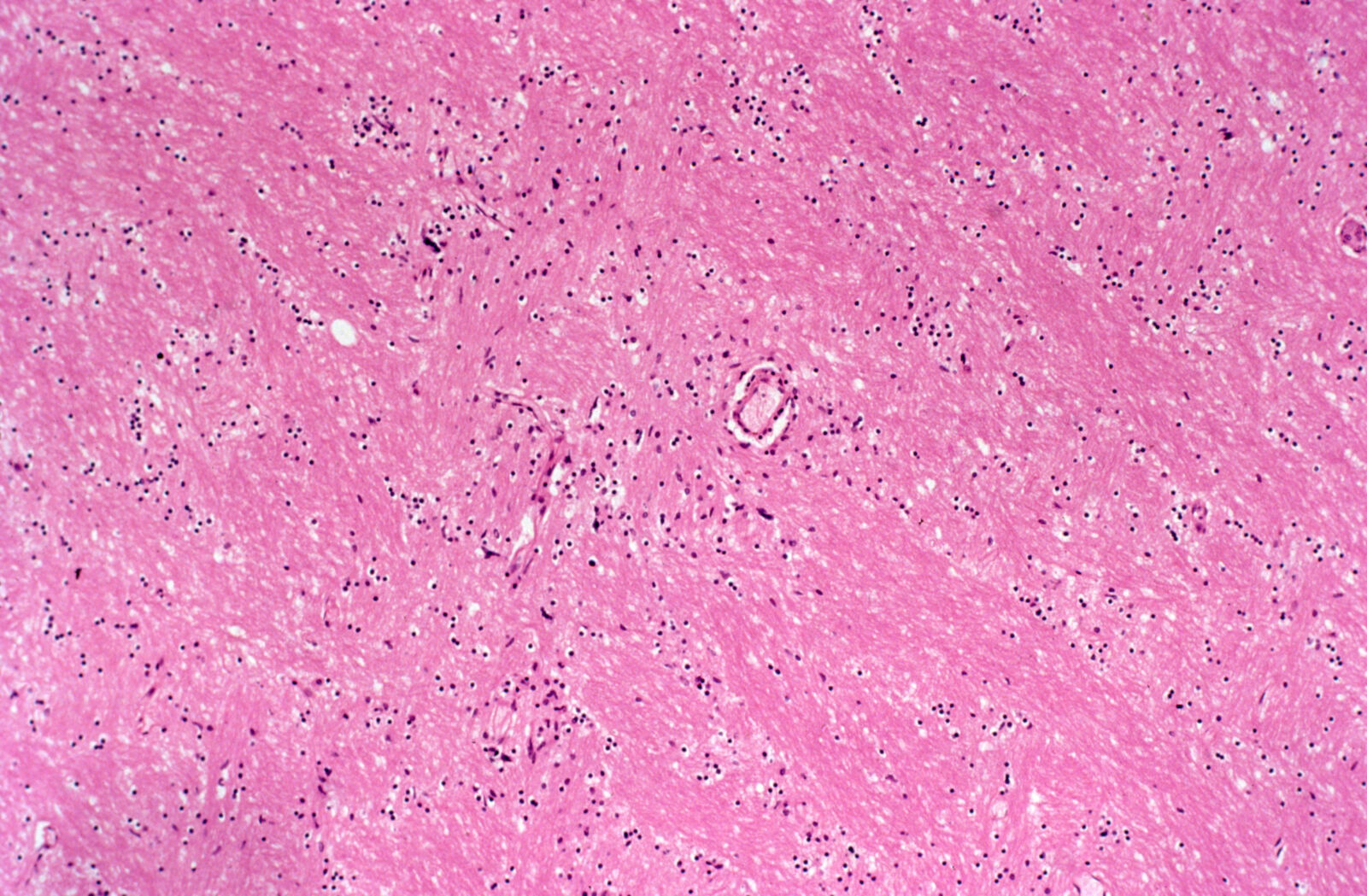 Brain: HIV encephalitis, hematoxylin and eosin of cerebral white matter with reactive gliosis