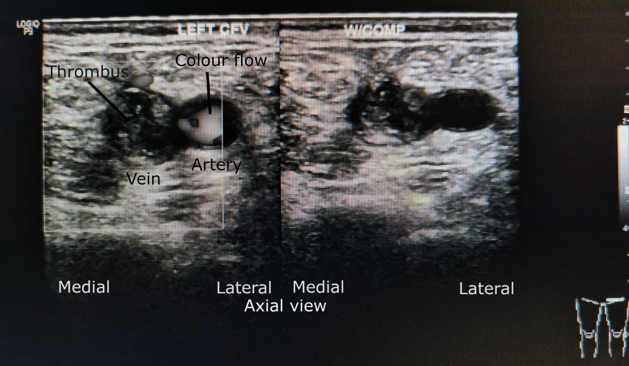 Duplex ultrasound of the common femoral vein filled with intraluminal thrombus