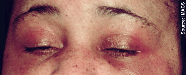 Heliotrope rash: violaceous discoloration of the upper eyelids in dermatomyositis