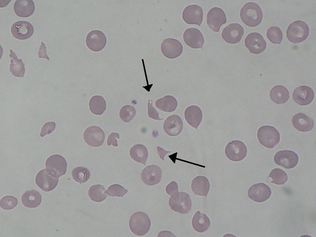 Blood smear showing schistocytes in HUS