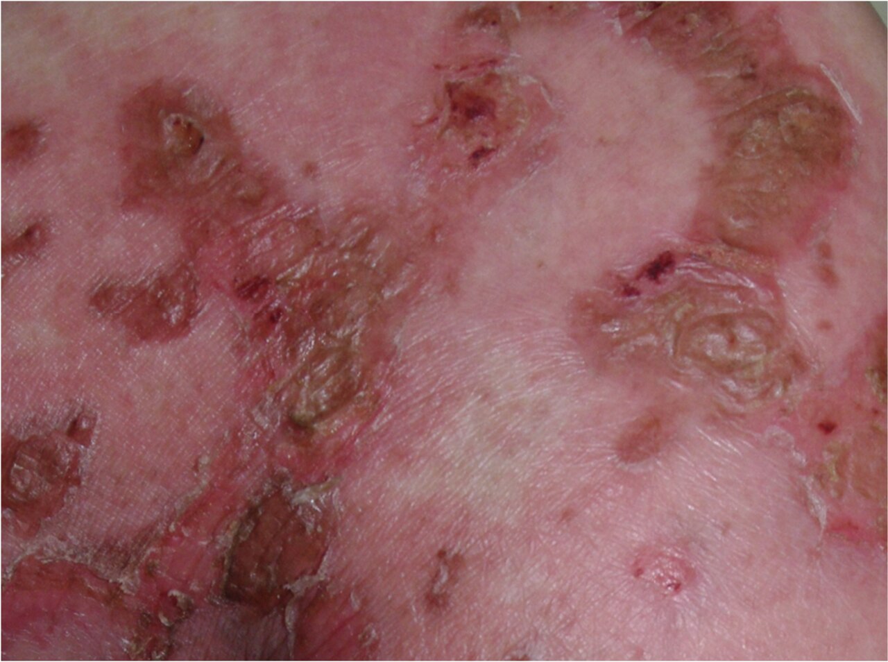 Necrolytic migratory erythema rash in glucagonoma