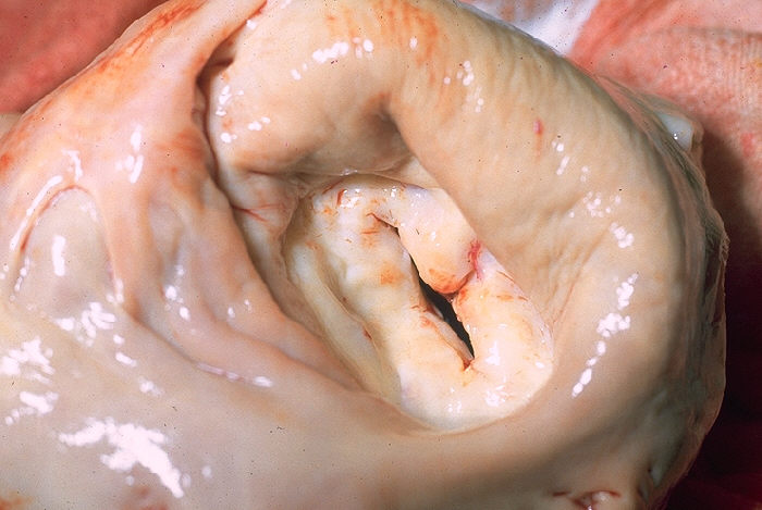 Gross pathology of rheumatic mitral stenosis showing the fish-mouth valve, a valvular cause of atrial fibrillation that mandates warfarin