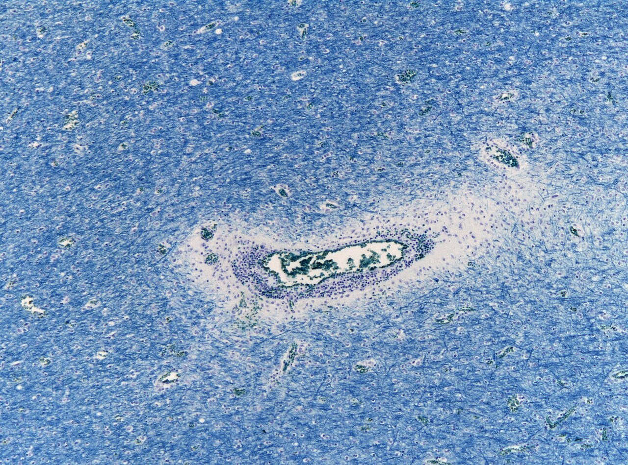 Myelin stain of white matter with an area of demyelination