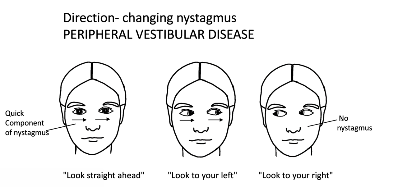 Diagram of nystagmus quick-component direction in peripheral vestibular disease