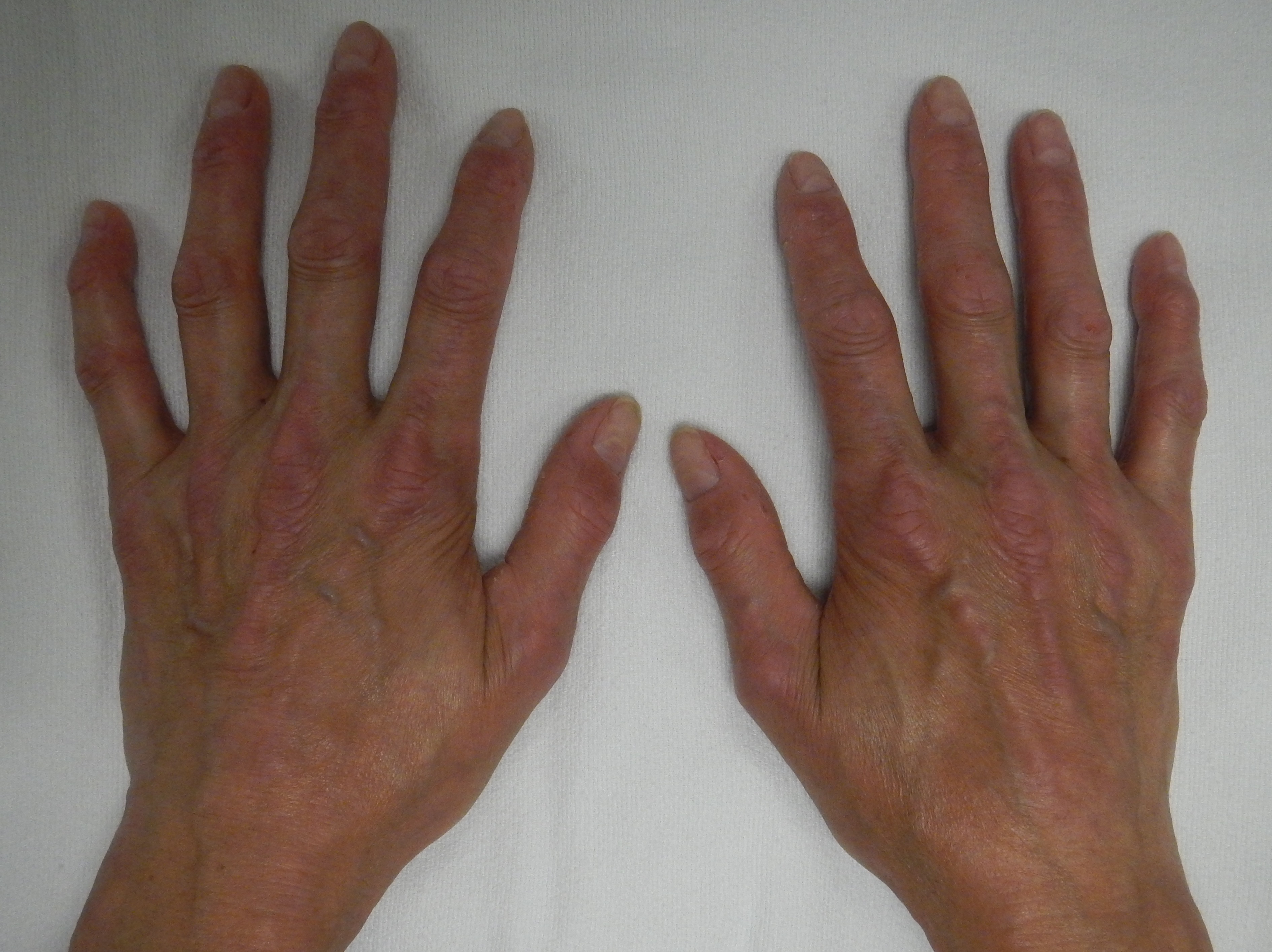 Sclerodactyly: tight, tapered, shiny fingers in systemic sclerosis