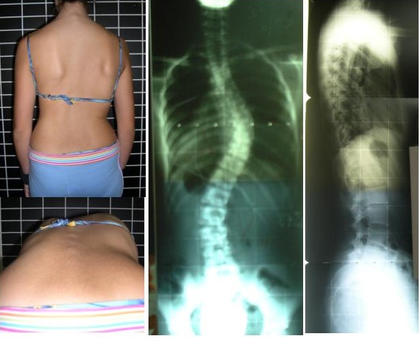 Adam's forward bend test with scoliosis X-rays