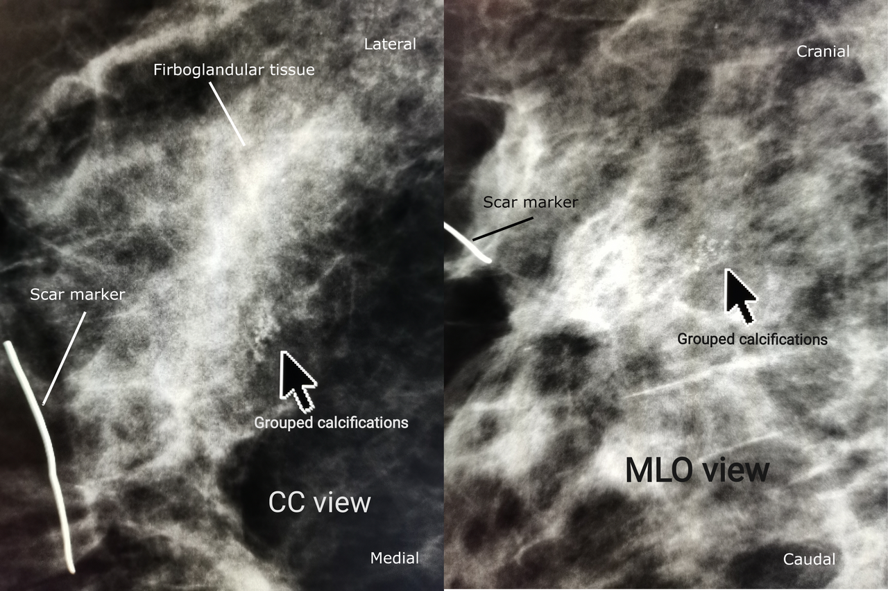 Mammogram film in CC and MLO views showing breast tissue
