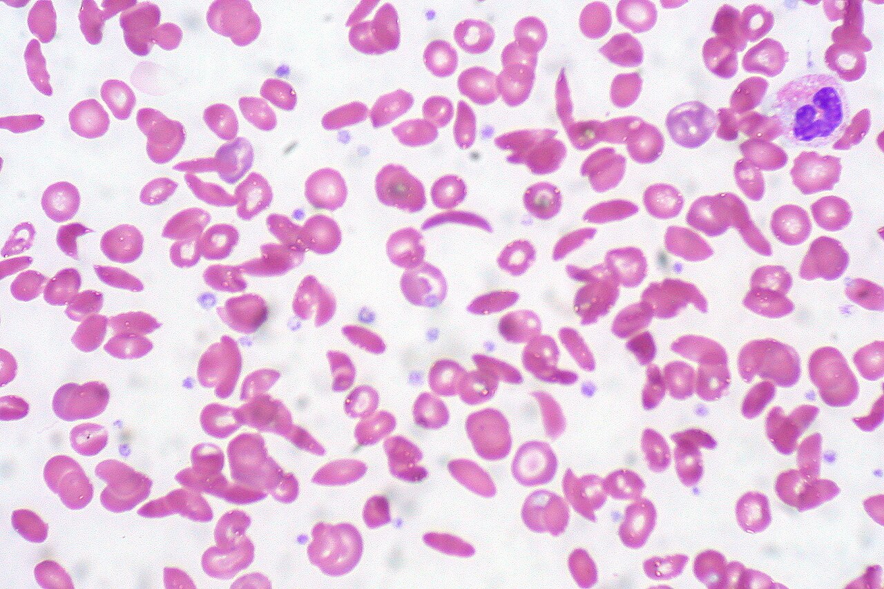 Sickle cell peripheral blood smear with sickled red cells