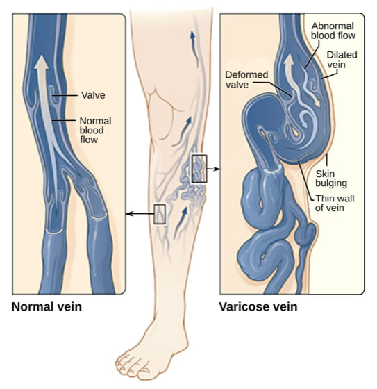 Diagram of varicose veins: incompetent valves and tortuous dilated superficial leg veins
