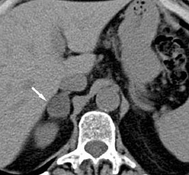 Axial abdominal computed tomography image with an arrow marking a small right adrenal lesion between the liver and the upper right kidney. The displayed pixels do not establish measured attenuation or hormonal function.