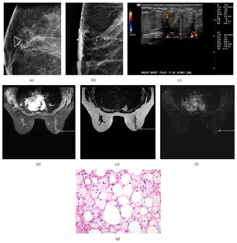 Multimodal breast imaging and histology panels illustrating fat necrosis.
