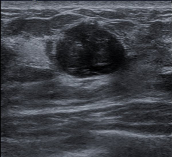Grayscale breast ultrasound labeled as fibroadenoma by the image creator.