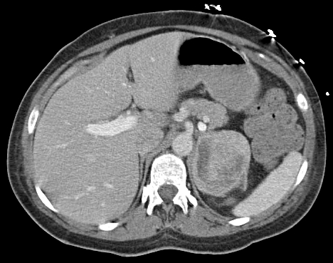 Axial contrast-enhanced CT of the upper abdomen showing a large left adrenal-region mass in a published pheochromocytoma image.