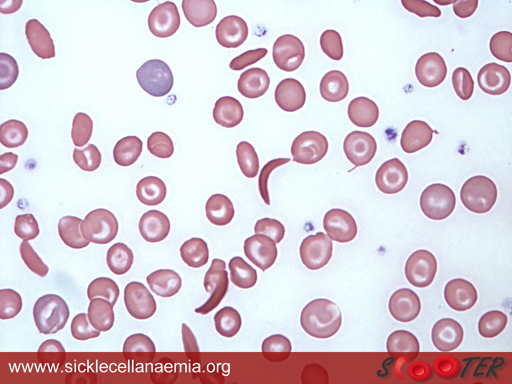 Blood smear with several elongated and crescent-shaped red cells among round cells.