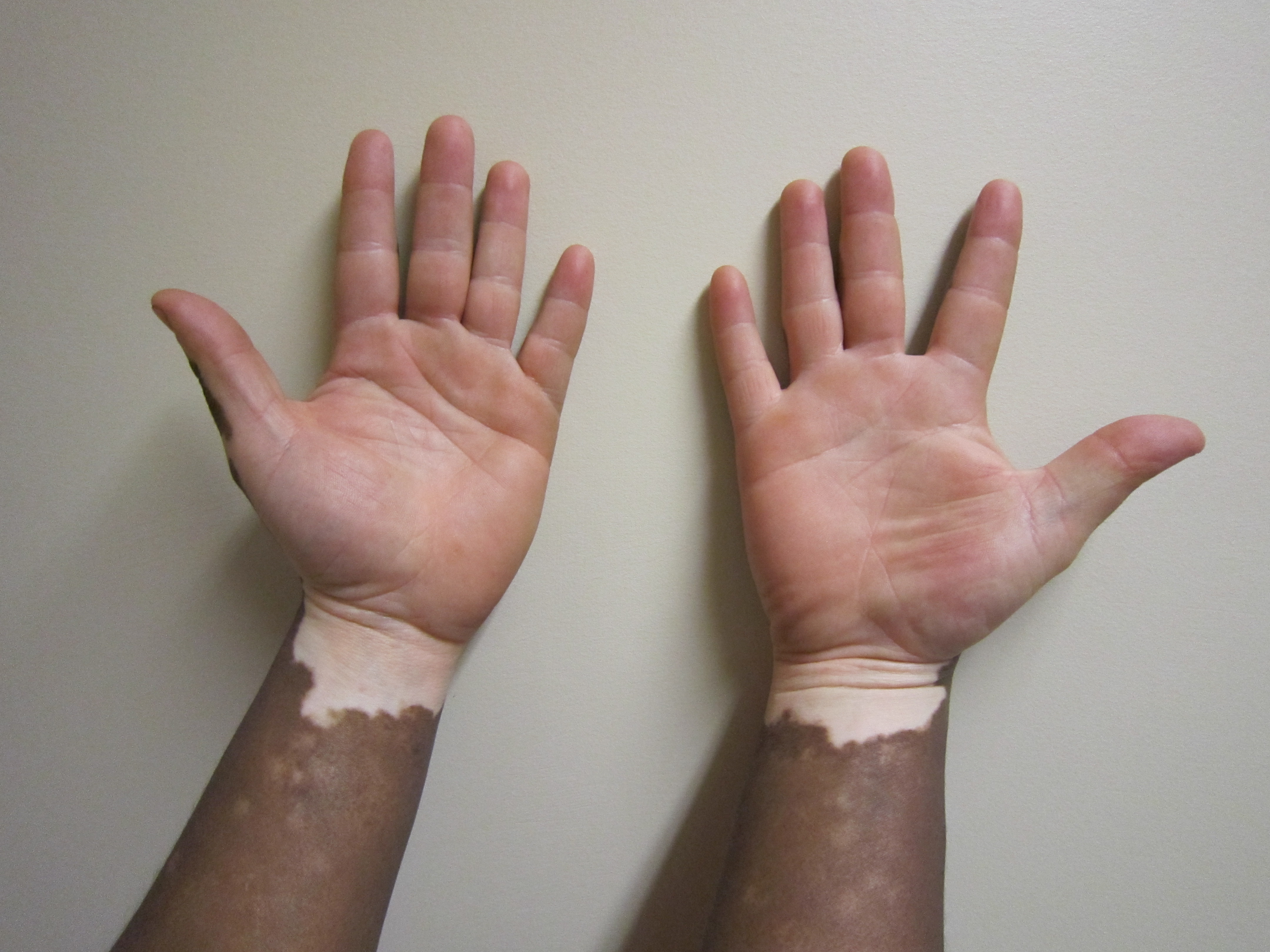 Original clinical photograph showing sharply demarcated depigmented areas on the volar wrists and hands.