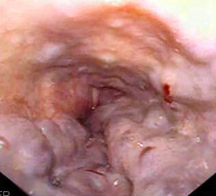 Endoscopic view with raised longitudinal esophageal venous columns and red surface markings.