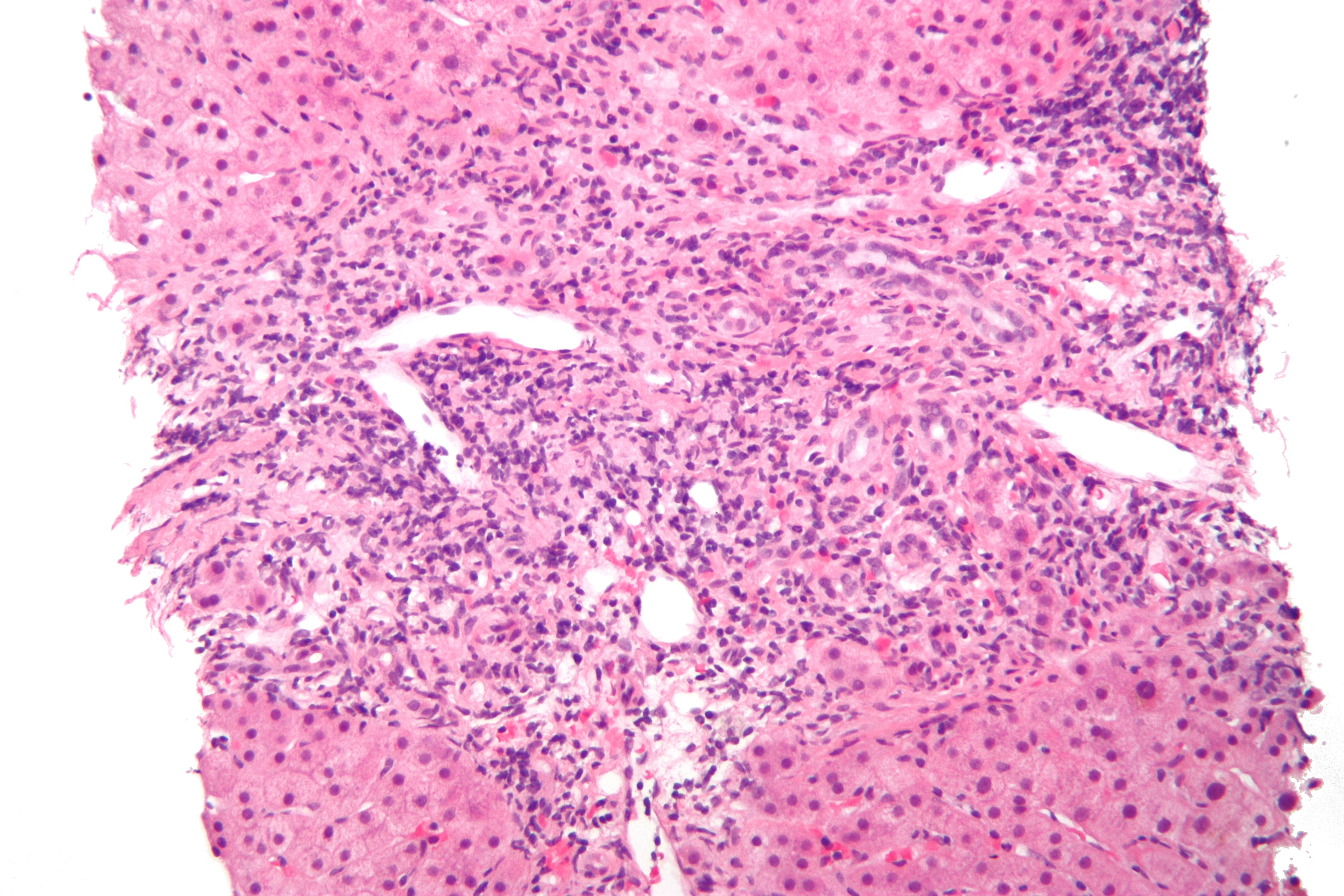 Hematoxylin and eosin micrograph with portal inflammatory cells around a small bile duct, including cells near its epithelial lining.
