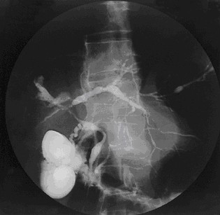 Contrast-filled biliary branches show irregular caliber and separated narrow segments with intervening wider ducts.