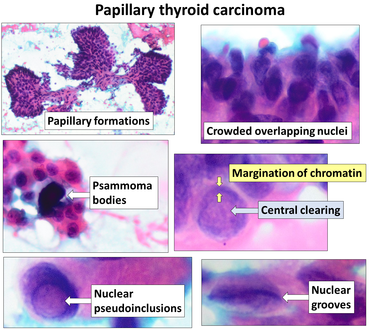 Pap-stained thyroid carcinoma cytology montage showing papillary formations, crowded overlapping nuclei, psammoma bodies, nuclear clearing, pseudoinclusions and grooves.