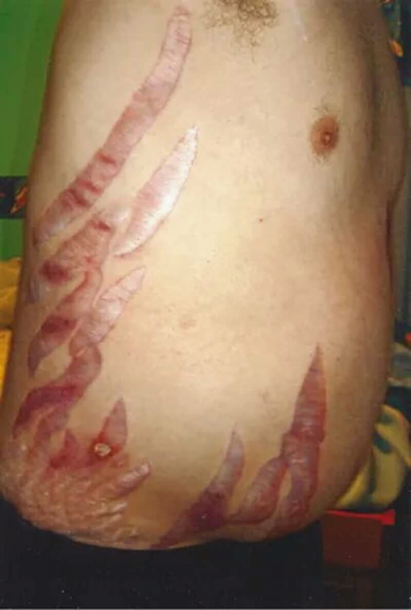Clinical photograph showing severe wide abdominal stretch marks in a patient with Cushing syndrome.