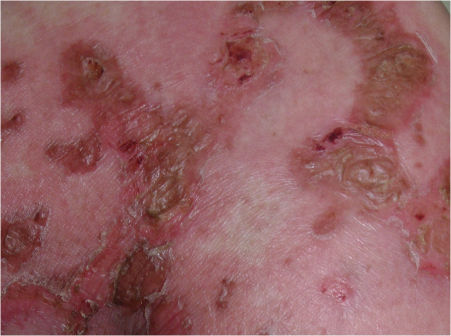 Clinical photograph showing sharply demarcated reddish gluteal plaques with superficial erosion and crusting in a published patient with glucagonoma.