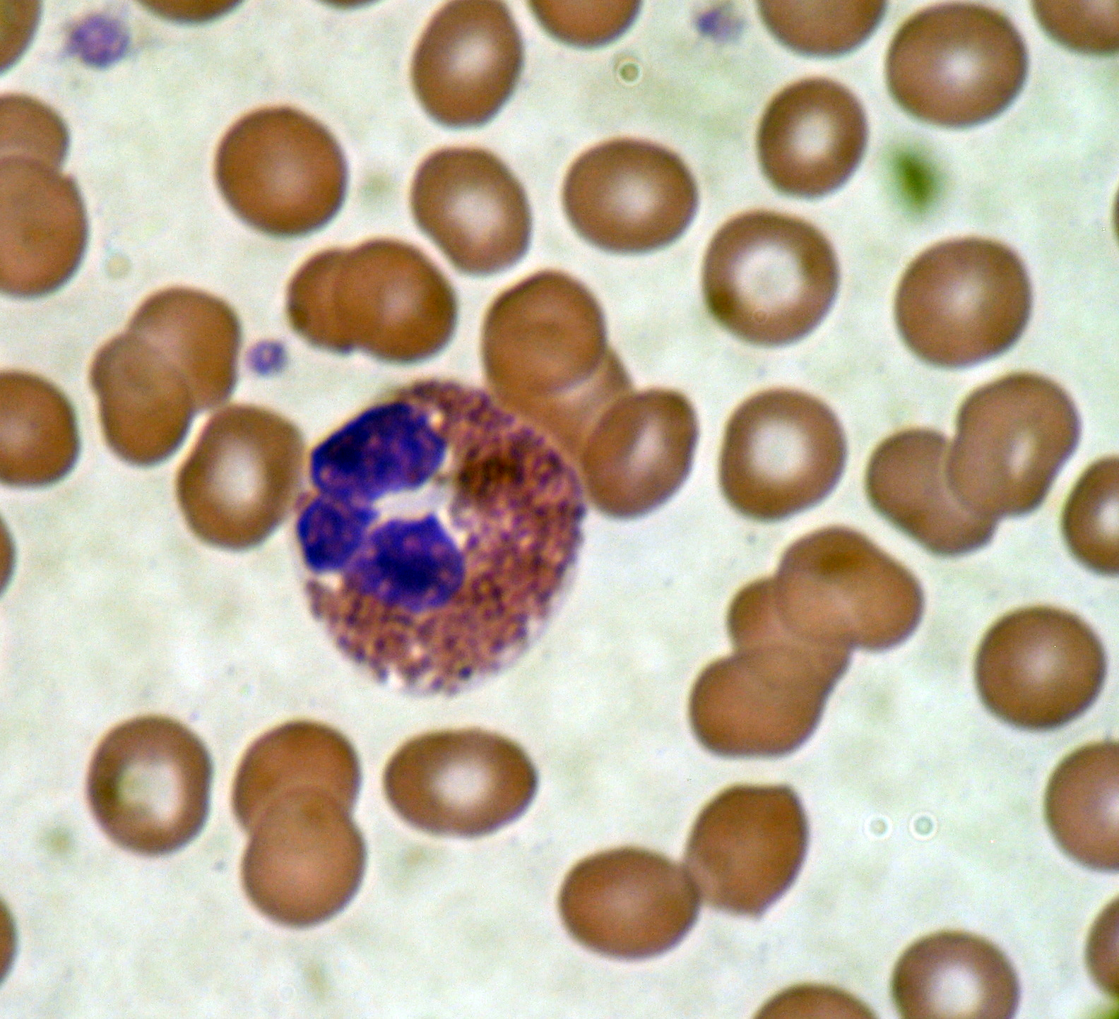 A stained peripheral-blood smear shows an eosinophil with a bilobed nucleus and prominent red-orange cytoplasmic granules.